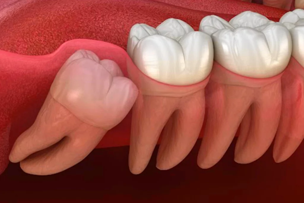 Wisdom Tooth Pain Home Remedy